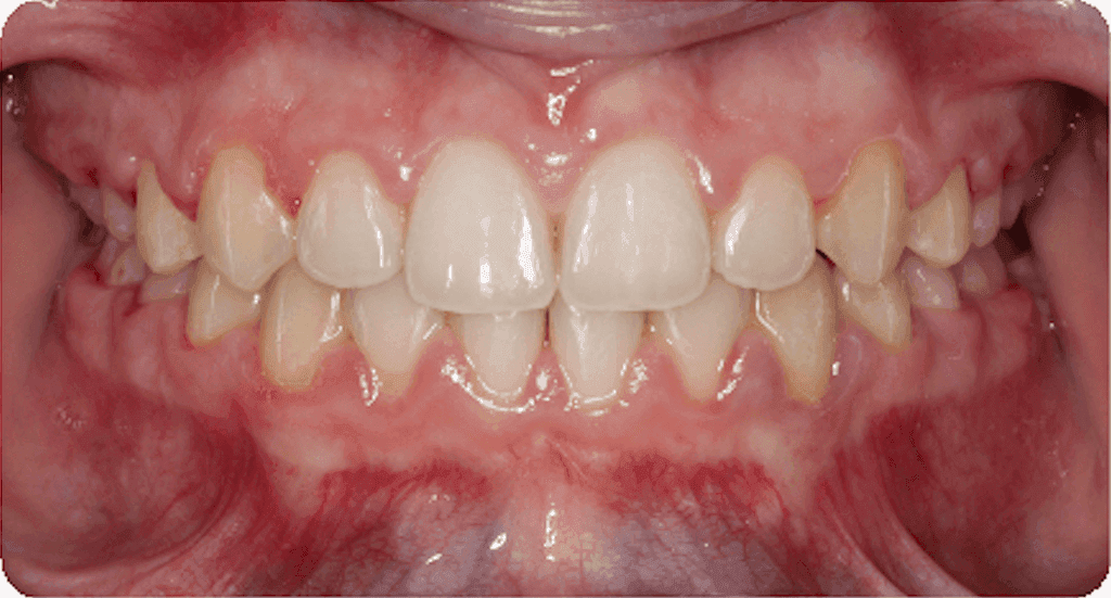 Deep bite: after orthodontic treatment