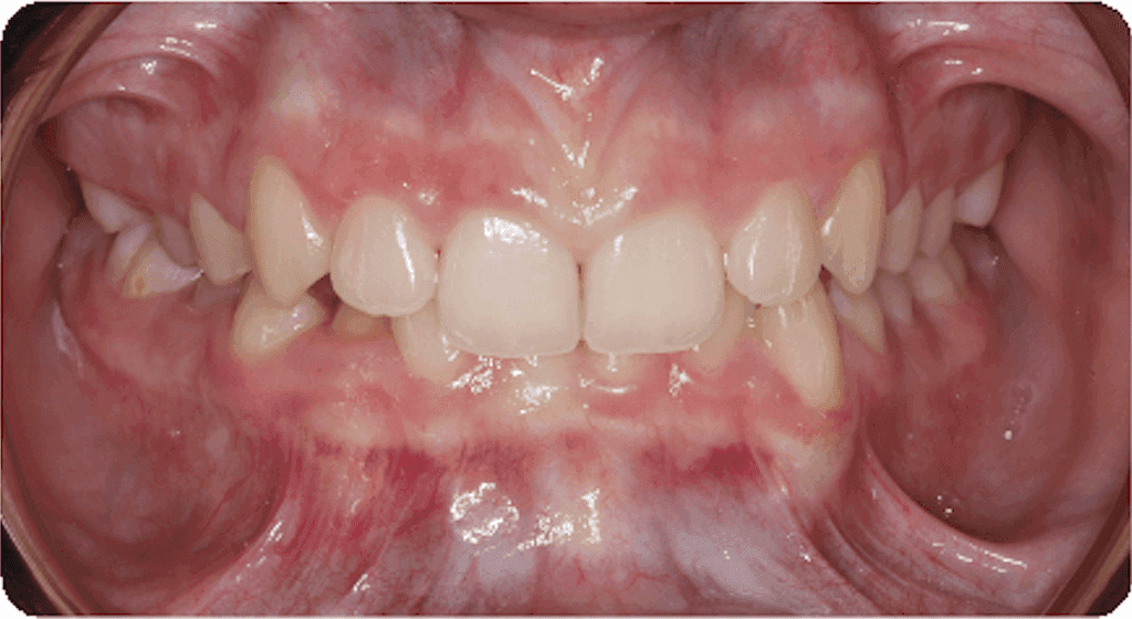 Deep bite: before orthodontic treatment