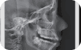 Side-view cephalometric X-ray example
