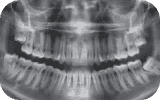 Panoramic dental X-ray example