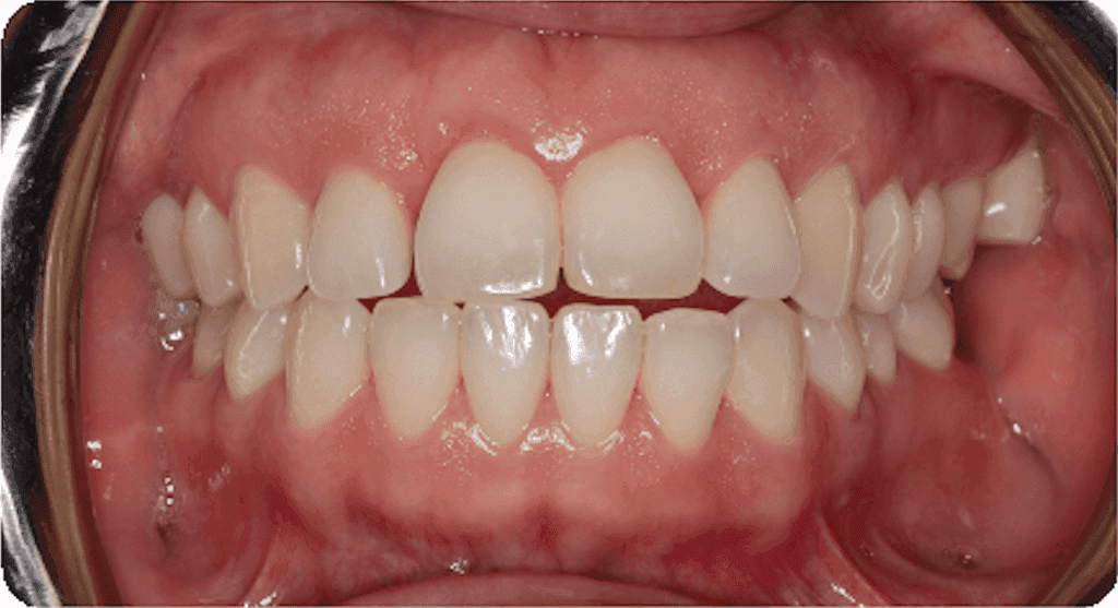 Open bite: before orthodontic treatment