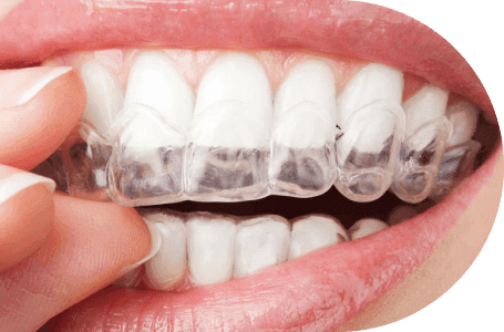 Clear removable aligners fitted over teeth