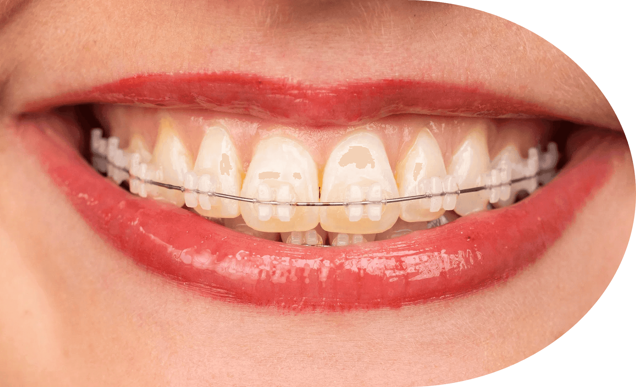 LightForce custom brackets and orthodontic wire