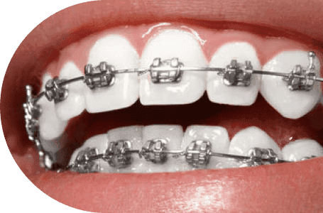 Traditional metal braces on upper and lower teeth