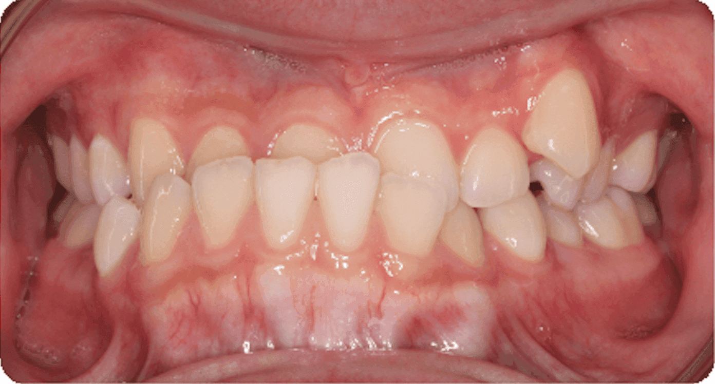 Clase III sin cirugía, vista frontal: antes del tratamiento de ortodoncia. Desde este ángulo, los dientes delanteros inferiores se sitúan por delante de los superiores. Esta mordida invertida puede dificultar la mordida y la masticación, y contribuir al desgaste dental desigual.