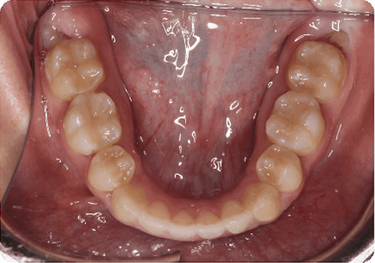 Apiñamiento, vista oclusal de la arcada inferior: después del tratamiento de ortodoncia. Los dientes delanteros inferiores siguen una curva más uniforme, con menos superposición y rotación. Esta alineación más regular puede facilitar la limpieza alrededor de cada diente y a lo largo del borde de las encías.