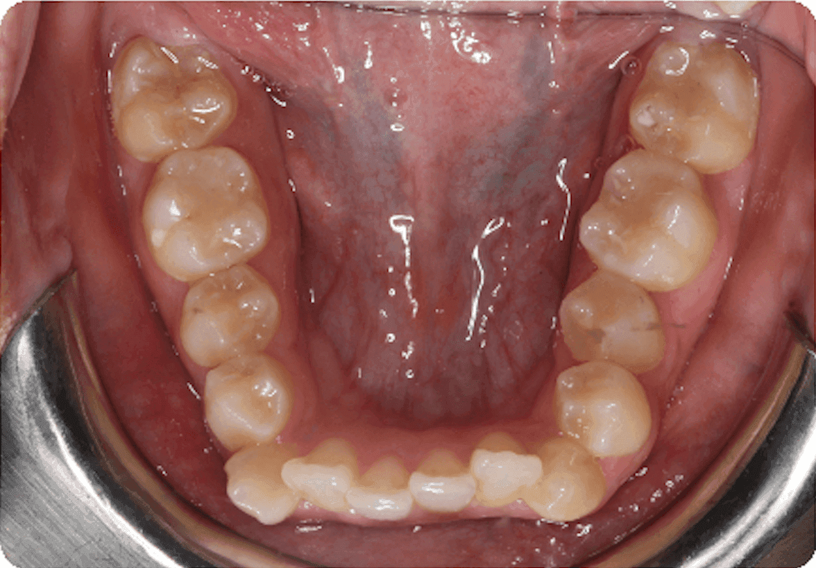 Apiñamiento, vista oclusal de la arcada inferior: antes del tratamiento de ortodoncia. Desde arriba, varios dientes delanteros inferiores se superponen y giran hacia dentro o fuera. Estas zonas de difícil acceso pueden retener placa y comida, lo que complica la limpieza diaria.