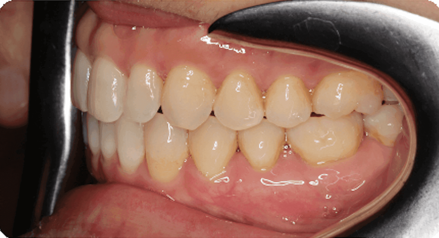 Tratamiento Invisalign, vista lateral: después del tratamiento de ortodoncia. La vista lateral muestra que los dientes superiores e inferiores encajan mejor. Un mejor contacto dental puede ayudar a que los dientes trabajen juntos de forma más eficaz al masticar.