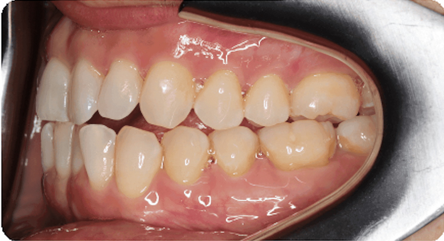 Tratamiento Invisalign, vista lateral: antes del tratamiento de ortodoncia. La vista lateral muestra espacios entre algunas zonas de las filas de dientes superiores e inferiores. Cuando los dientes no contactan de manera uniforme, pueden ser menos eficaces al morder y masticar.